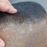 Hygiene and Scalp Disorders